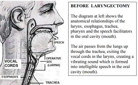 Ser laringectomizado y qué esperar, Labex Trade