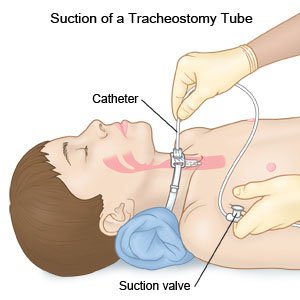 succión del tubo endotraqueal, Labex Trade