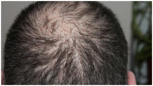 Laringectomía - Cómo manejar el dolor de la pérdida de cabello por radiación